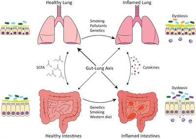 Links Between Inflammatory Bowel Disease and Chronic Obstructive Pulmonary Disease